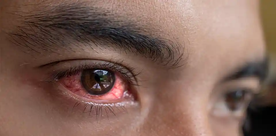 best eye hospital in kolkata for red eye